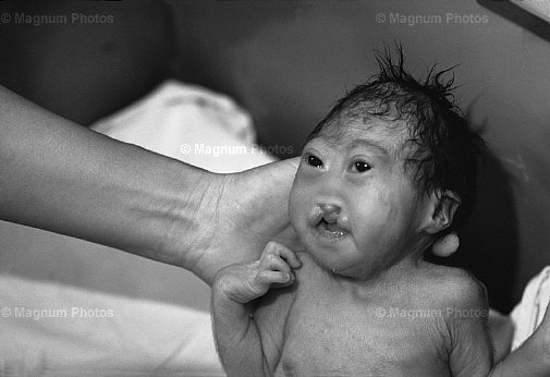 Vietnam, Ho Chi Minh City. Bambini deformati, al Tu Du Hospital -1.jpg